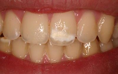 Hypomineralisation – What Causes Chalky Teeth?