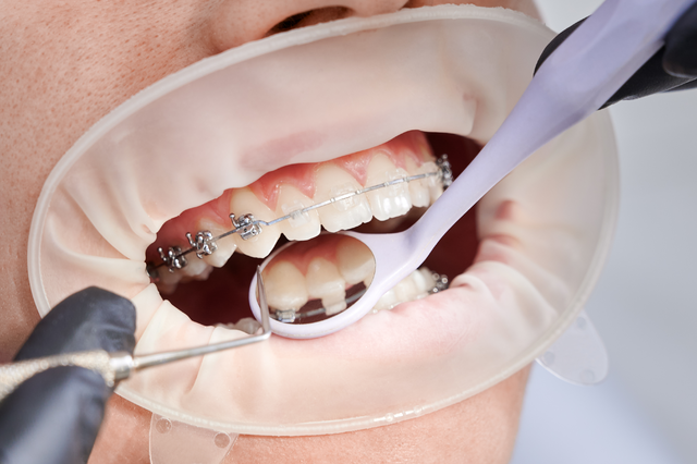 Traditional Braces